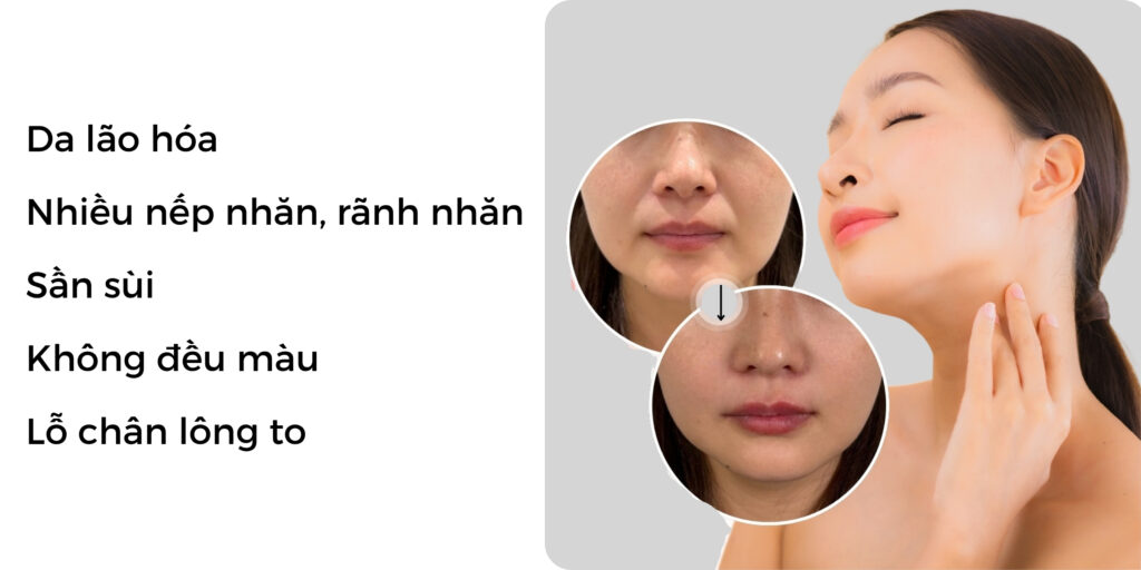 Tiêm Juvederm Volite giá bao nhiêu? Hiệu quả chống lão hóa da thế nào? 5 Ai nên tiêm Juvederm Volite