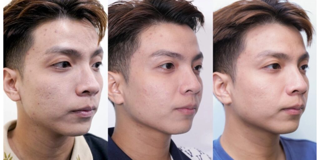 Tiêm skin booster Belotero Revive giá bao nhiêu? Hiệu quả trẻ hóa da thế nào? 5 Belotero Revive có công dụng gì cho da