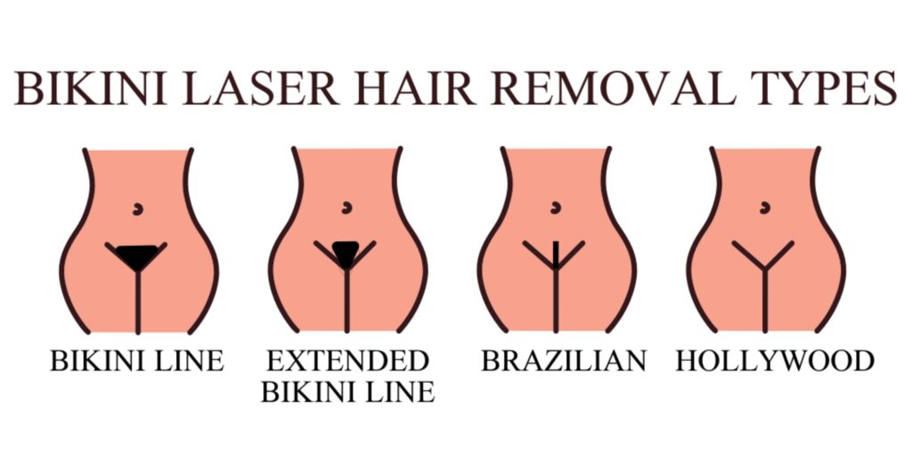 Triệt lông bikini giá bao nhiêu? Bảng giá mới nhất 2025 3 Các mẫu triệt lông bikini tạo hình được ưa chuộng