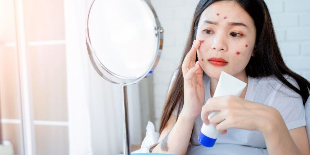 Trị mụn bằng laser giá bao nhiêu? Gợi ý địa chỉ trị mụn uy tín TP. HCM 5 Cách chăm sóc da sau khi trị mụn bằng laser để đạt hiệu quả tốt nhất