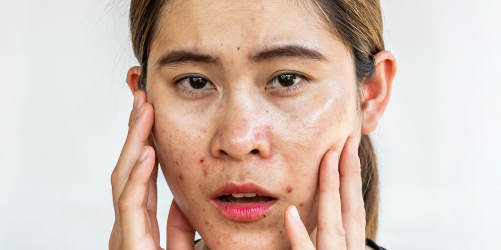 1 liệu trình trị mụn tại spa bao nhiêu tiền? Có nên đầu tư không? 3 Có nên lựa chọn spa điều trị mụn giá rẻ