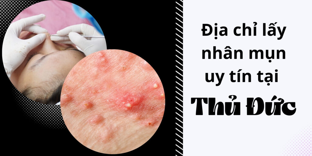 Địa chỉ lấy nhân mụn uy tín Thủ Đức thumbnail