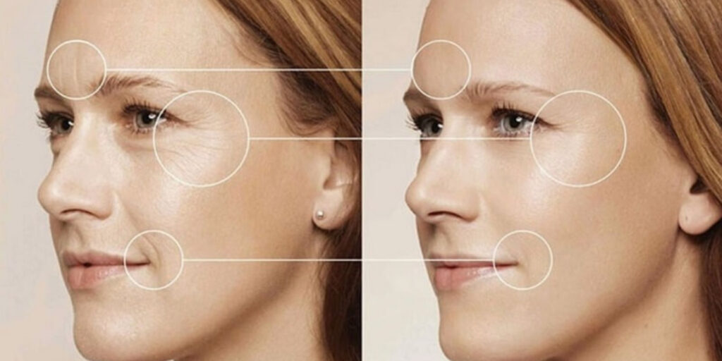 Tiêm Rejuran Healer giá bao nhiêu? Công dụng và quy trình tiêm tại Emme Beauty & Spa 4 Đối tượng nào nên tiêm Rejuran Healer