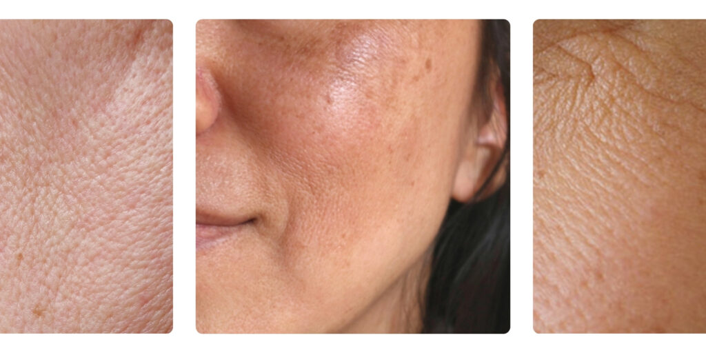 Tiêm skin booster Belotero Revive giá bao nhiêu? Hiệu quả trẻ hóa da thế nào? 6 Đối tượng nào phù hợp để tiêm Belotero Revive