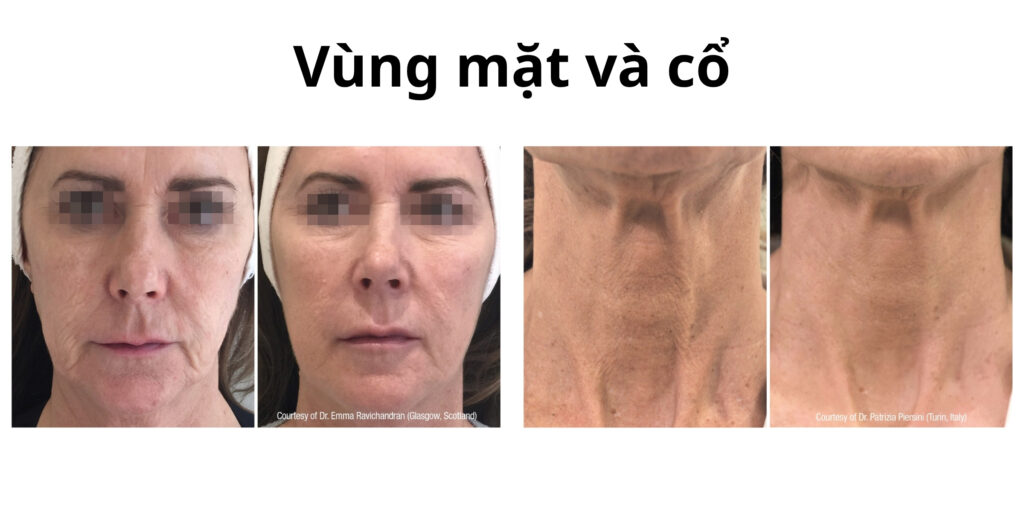 Đối tượng phù hợp với Profhilo