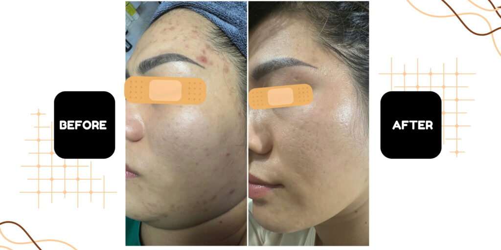 Emme Beauty & Spa địa chỉ nặn mụn, trị mụn uy tín tại TP. HCM