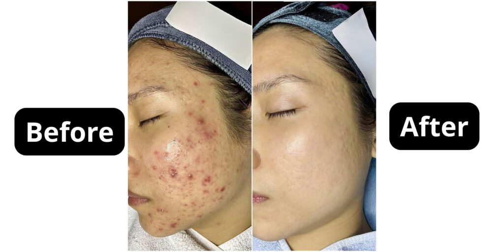 Peel da trị mụn giá bao nhiêu? Hiệu quả và lưu ý trước khi thực hiện 4 Hiệu quả của peel da trong trị mụn