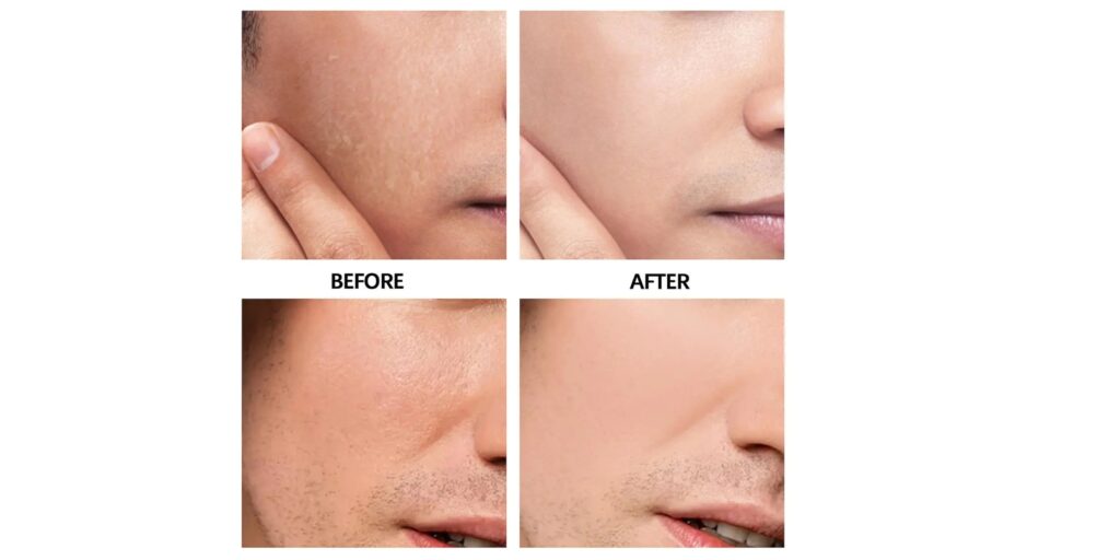 Triệt lông mặt giá bao nhiêu 1 liệu trình? Gợi ý địa chỉ uy tín tại TP. HCM 5 Hiệu quả sau khi triệt lông mặt tại EMME Beauty & Spa