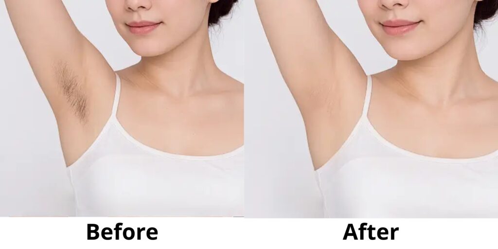 Triệt lông vĩnh viễn giá bao nhiêu? Hiệu quả và review thực tế 5 Hiệu quả sau liệu trình triệt lông vĩnh viễn tại EMME Beauty & Spa