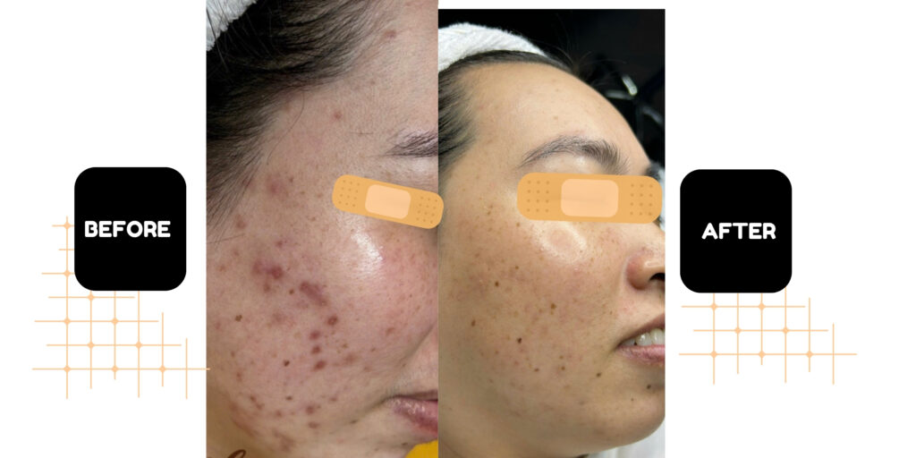 Hiệu quả trị mụn của phương pháp lăn kim