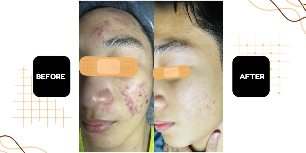 Lăn kim có an toàn không Bao lâu thấy hiệu quả