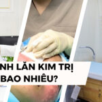 Liệu trình lăn kim trị mụn giá bao nhiêu? Bảng giá mới nhất 2025 4 Liệu trình lăn kim trị mụn giá bao nhiêu