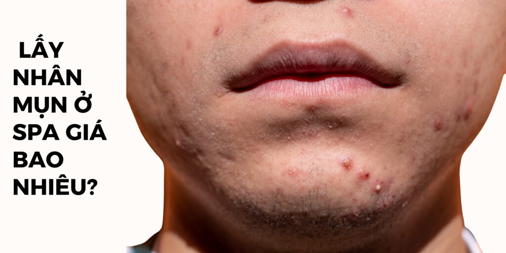 Liệu trình lấy nhân mụn ở spa giá bao nhiêu