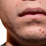 Lấy nhân mụn ở spa giá bao nhiêu? Có khác gì so với tự nặn mụn tại nhà 5 Liệu trình lấy nhân mụn ở spa giá bao nhiêu