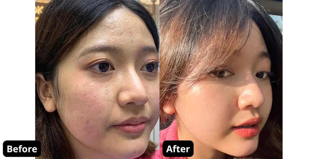 Tiêm Rejuran Healer giá bao nhiêu? Công dụng và quy trình tiêm tại Emme Beauty & Spa 6 Liệu trình tiêm Rejuran gồm mấy buổi và duy trì được bao lâu