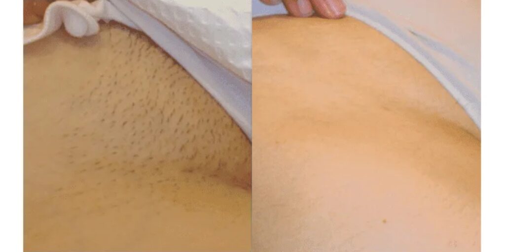 Triệt lông bikini giá bao nhiêu? Bảng giá mới nhất 2025 7 Lưu ý khi lựa chọn địa chỉ triệt lông bikini uy tín (2)