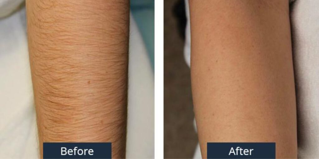 Giá triệt lông tay vĩnh viễn là bao nhiêu? Bảng giá mới nhất năm 2025 5 Mách bạn địa chỉ triệt lông tay uy tín và an toàn tại TP. HCM