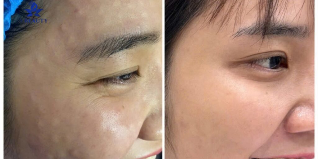 Karisma là gì? Tiêm BAP Karisma giá bao nhiêu? 7 Nên tiêm BAP Karisma ở đâu uy tín tại TP. HCM