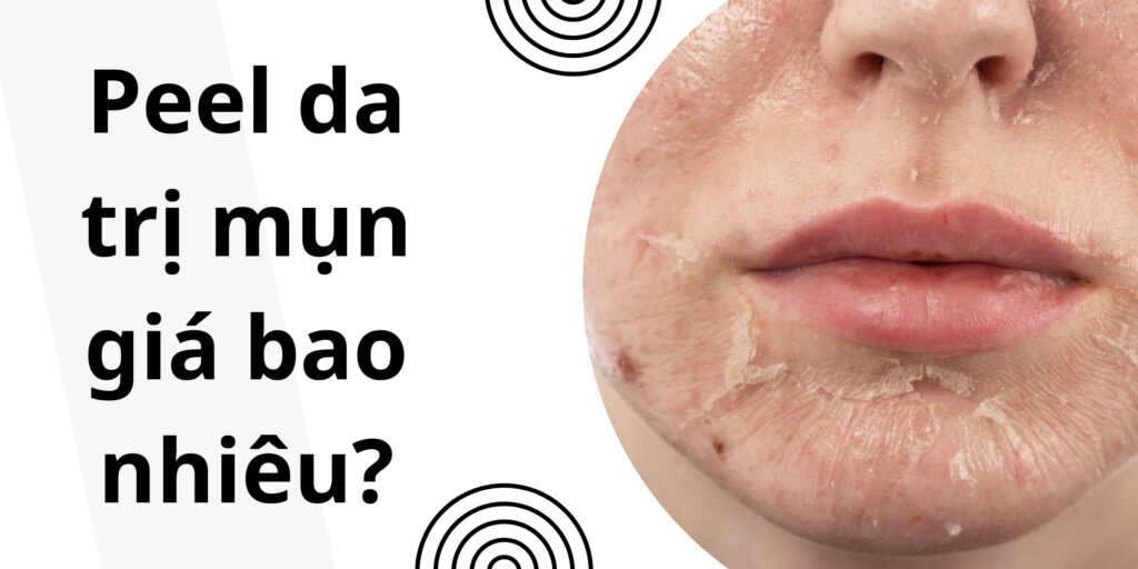 Peel da trị mụn giá bao nhiêu thumb