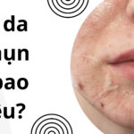 Peel da trị mụn giá bao nhiêu thumb