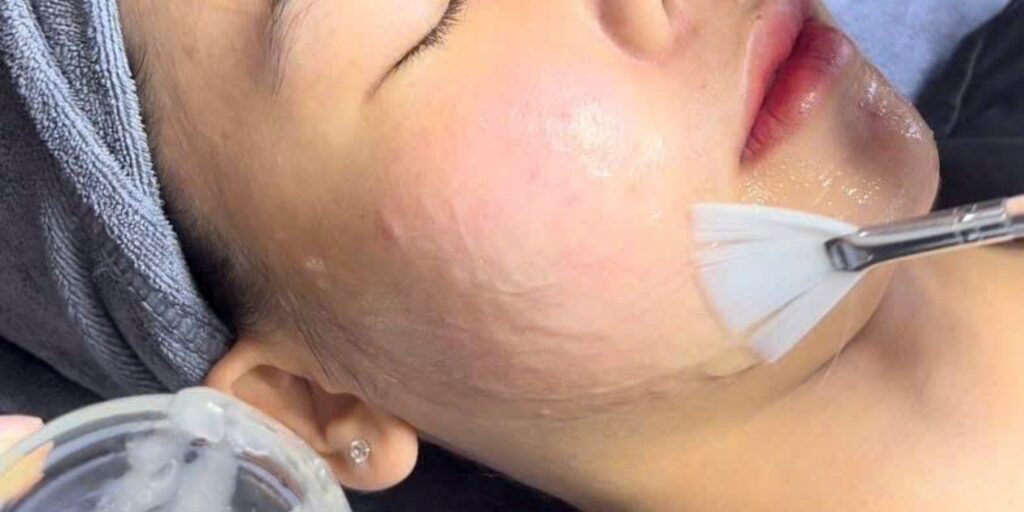 Peel da trị mụn giá bao nhiêu? Hiệu quả và lưu ý trước khi thực hiện 2 Peel da trị mụn là gì