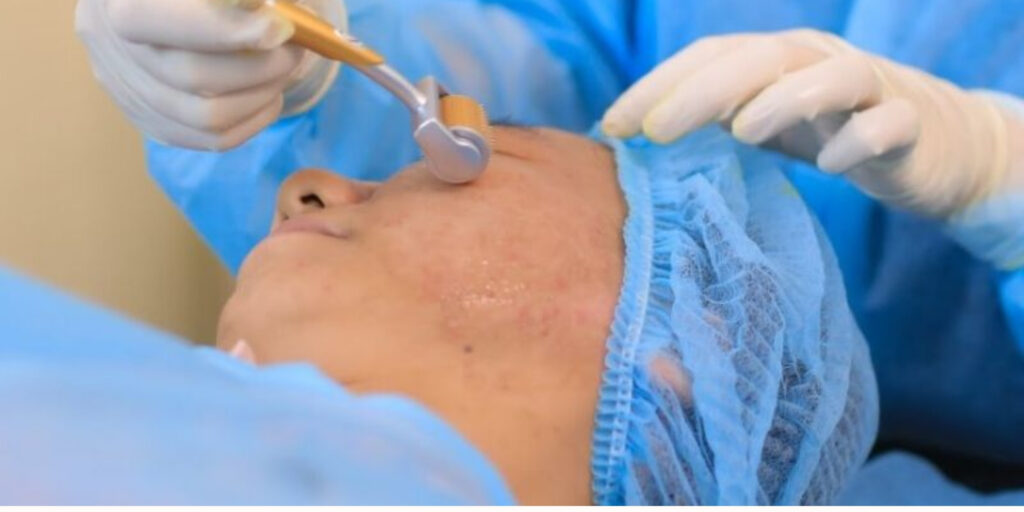 Phương pháp lăn kim là gì