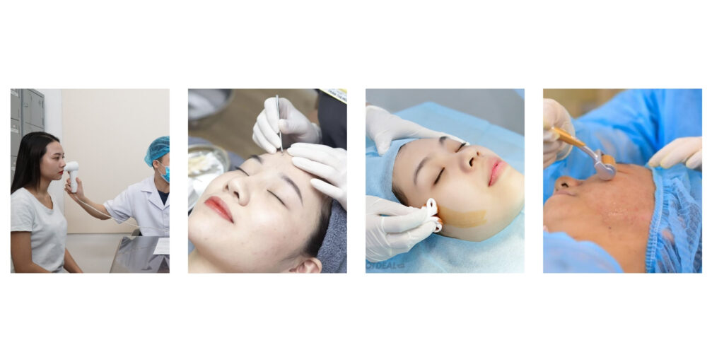 Quy trình lăn kim trị mụn tại Emme Beauty & Spa