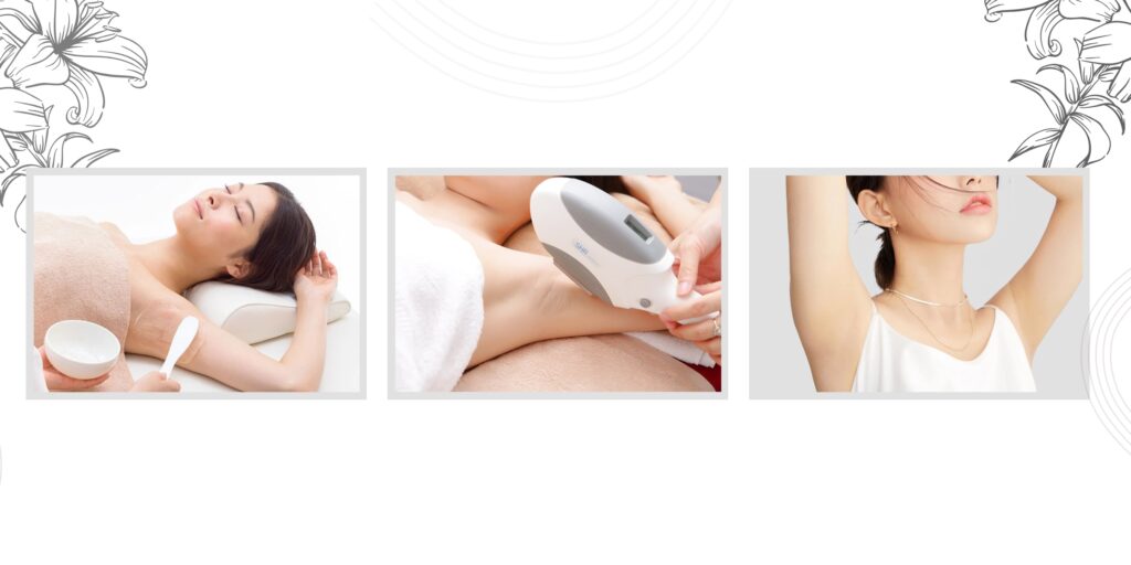 Triệt lông nách giá bao nhiêu? Bảng giá và công nghệ triệt lông an toàn tại EMME Beauty & Spa 3 Quy trình triệt lông nách chuẩn y khoa tại EMME Beauty & Spa