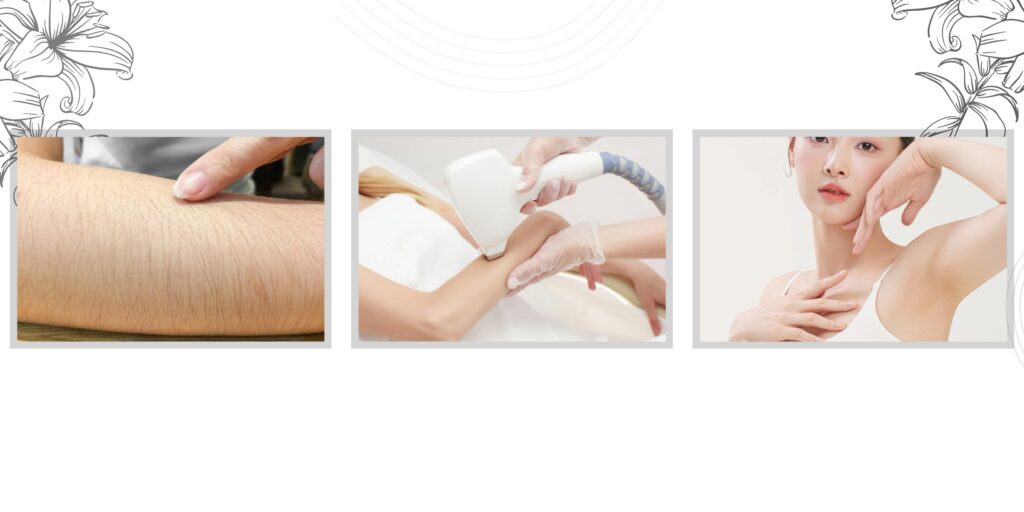 Giá triệt lông tay vĩnh viễn là bao nhiêu? Bảng giá mới nhất năm 2025 4 Quy trình triệt lông tay chuẩn y khoa tại EMME Beauty & Spa