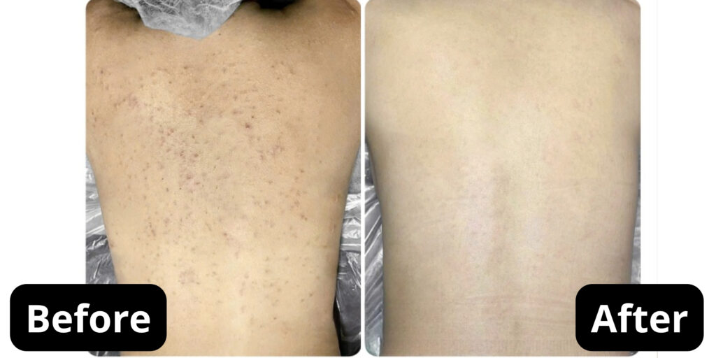 Spa trị mụn lưng TP. HCM: Quy trình, chi phí và review hiệu quả tại Emme Beauty & Spa 6 Review hiệu quả sau khi trị mụn lưng tại Emme Beauty & Spa