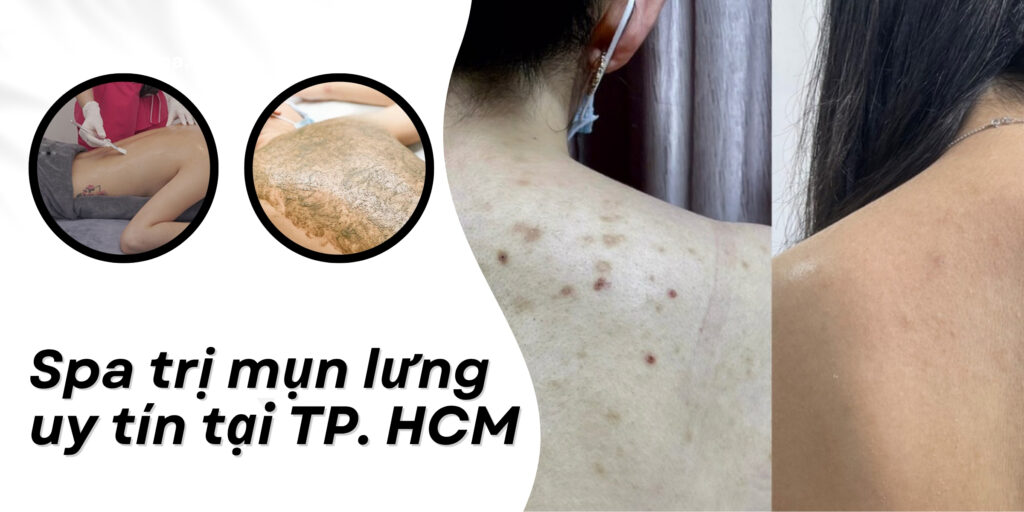 Spa trị mụn lưng TP. HCM thumb