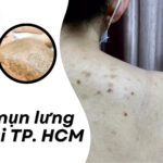 Spa trị mụn lưng TP. HCM thumb