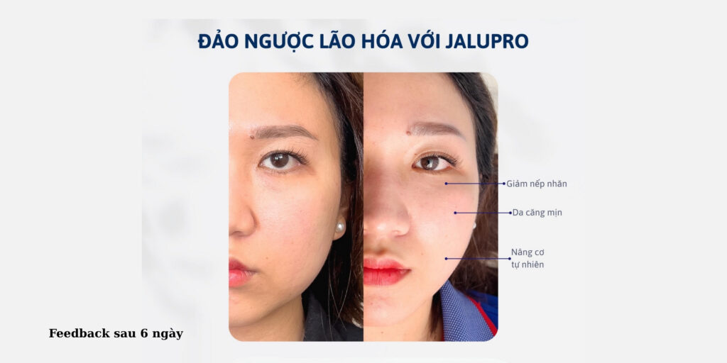 Jalupro Super Hydro là gì? Công dụng, chi phí và quy trình tiêm tại Emme Beauty & Spa 6 Tiêm Jalupro Super Hydro bao lâu thì thấy hiệu quả