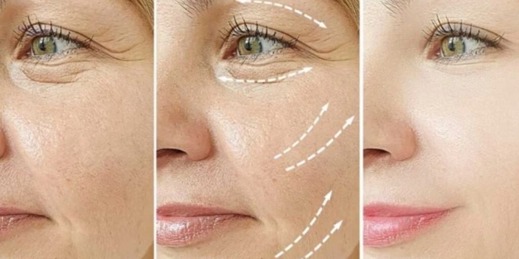 Jalupro Super Hydro là gì? Công dụng, chi phí và quy trình tiêm tại Emme Beauty & Spa 7 Tiêm Jalupro Super Hydro giá bao nhiêu