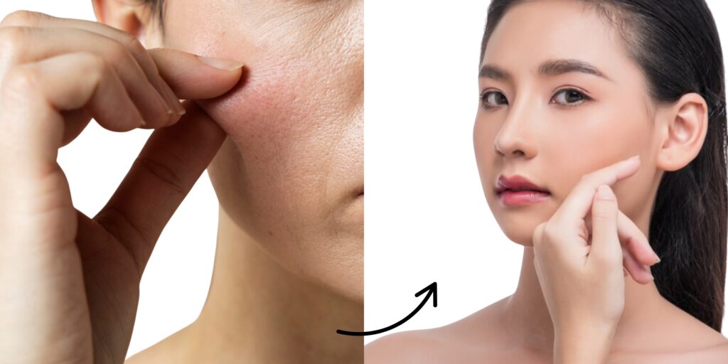 Tiêm Juvederm Volite giá bao nhiêu? Hiệu quả chống lão hóa da thế nào? 7 Tiêm Juvederm Volite bao lâu thì thấy hiệu quả và duy trì được bao lâu