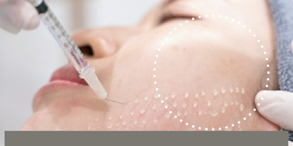 Tiêm Juvederm Volite giá bao nhiêu? Hiệu quả chống lão hóa da thế nào? 3 Tiêm Juvederm Volite giá bao nhiêu