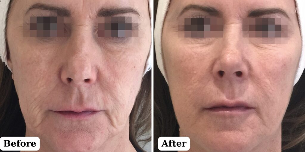 Tiêm Profhilo bao lâu thì thấy hiệu quả và kéo dài bao lâu