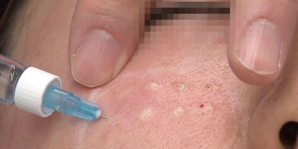 Tiêm Rejuran Healer giá bao nhiêu? Công dụng và quy trình tiêm tại Emme Beauty & Spa 7 Tiêm Rejuran Healer giá bao nhiêu