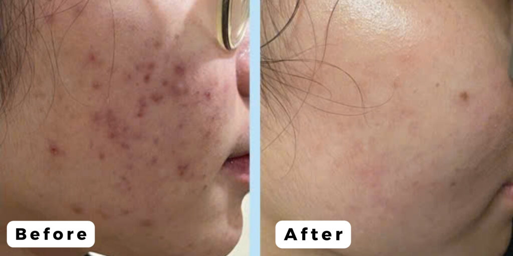 Trị mụn bằng laser giá bao nhiêu? Gợi ý địa chỉ trị mụn uy tín TP. HCM 3 Trị mụn bằng laser có tốt không