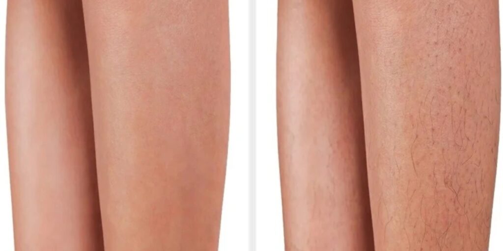 Triệt lông vĩnh viễn giá bao nhiêu? Hiệu quả và review thực tế 2 Triệt lông vĩnh viễn là gì Có thực sự vĩnh viễn không