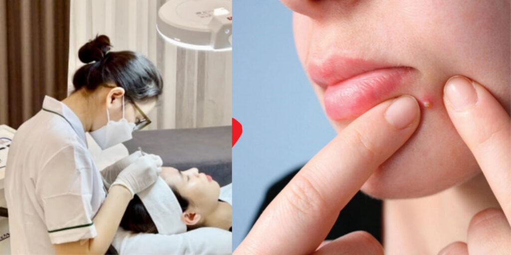 Ưu điểm khi lấy nhân mụn ở spa so với tự nặn tại nhà