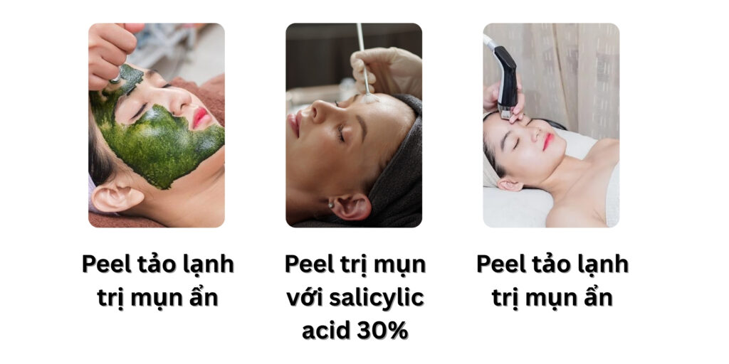 Peel da trị mụn giá bao nhiêu? Hiệu quả và lưu ý trước khi thực hiện 6 Ưu điểm và nhược điểm của peel da trị mụn