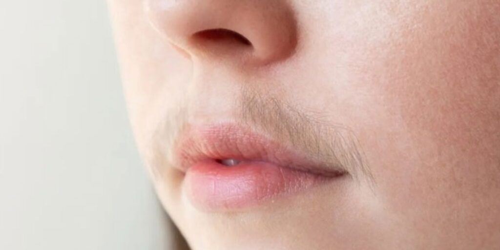 Triệt lông vĩnh viễn giá bao nhiêu? Hiệu quả và review thực tế 3 Ưu nhược điểm của triệt lông vĩnh viễn