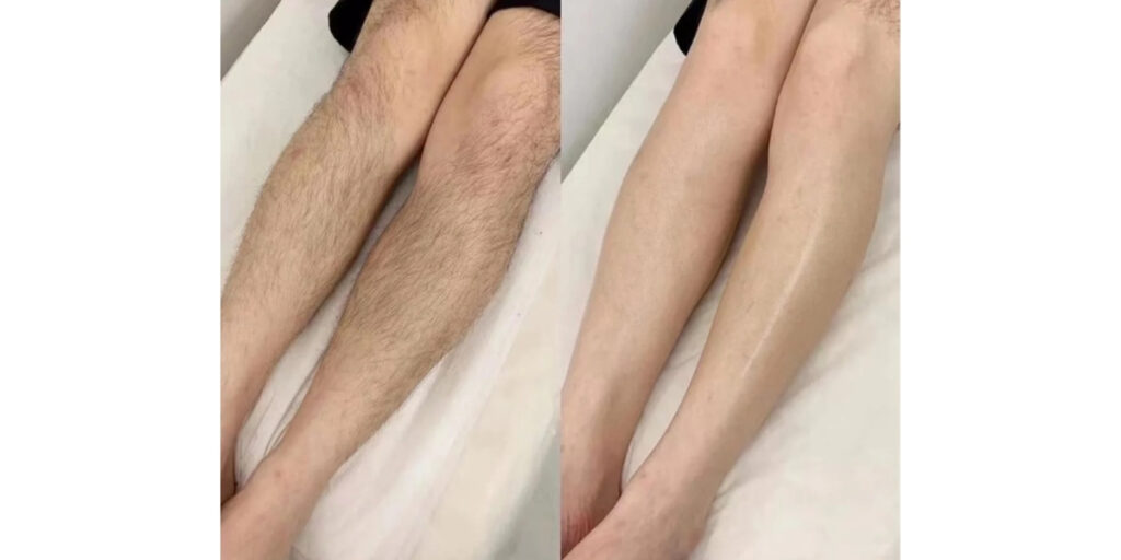 Triệt lông chân giá bao nhiêu? Bảng giá mới nhất 2025 3 Ưu và nhược điểm khi chọn triệt lông chân vĩnh viễn