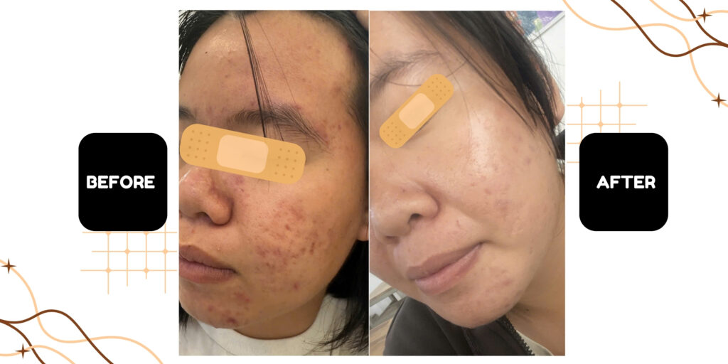 1 liệu trình trị mụn tại spa bao nhiêu tiền? Có nên đầu tư không? 4 Vì sao nên điều trị mụn tại Emme Beauty & Spa