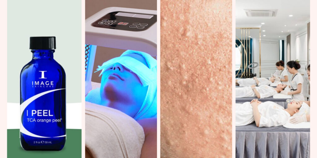 Peel da trị mụn giá bao nhiêu? Hiệu quả và lưu ý trước khi thực hiện 3 yếu tố ảnh hưởng đến chi phí peel da trị mụn