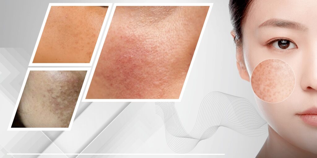 Ai nên và không nên tiêm meso trị nám