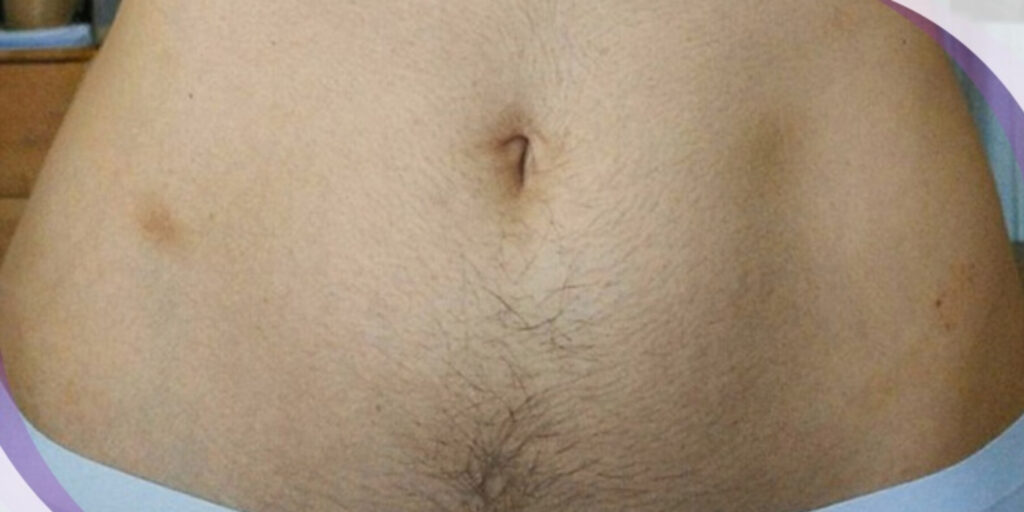 Giá triệt lông bụng bao nhiêu? Cập nhật bảng giá mới nhất 2025 9 Bao lâu mới cần triệt lông bụng 1 lần