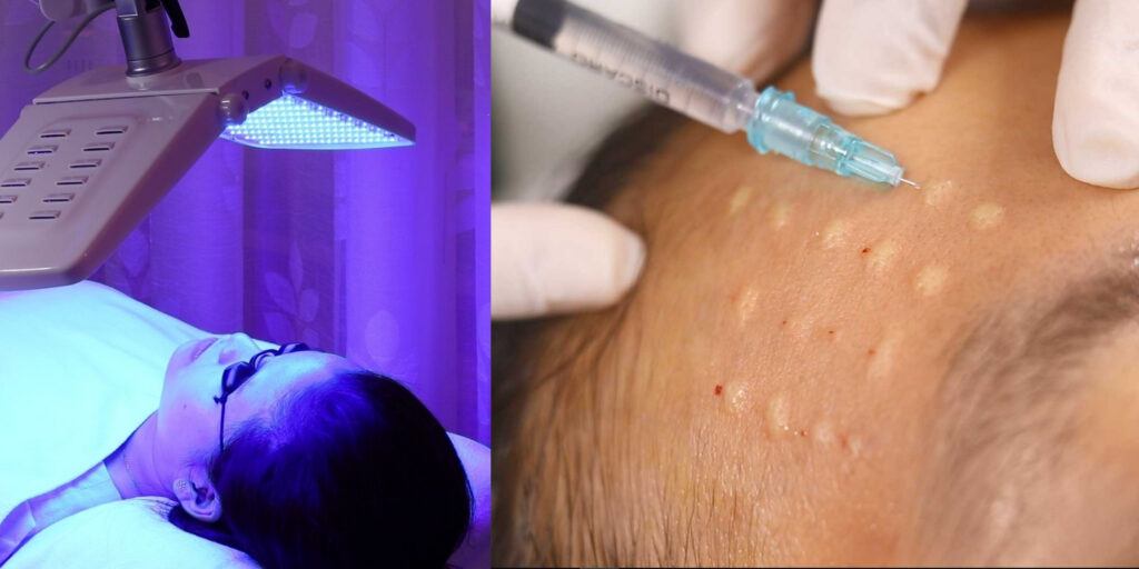 Các phương pháp trị mụn dành cho nam hiện nay