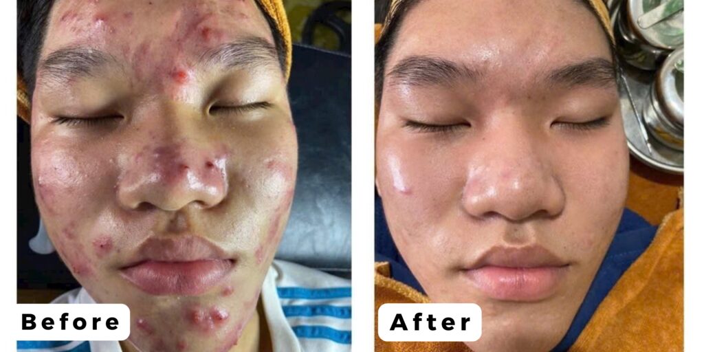 Chi phí trị mụn tại spa dành cho nam là bao nhiêu